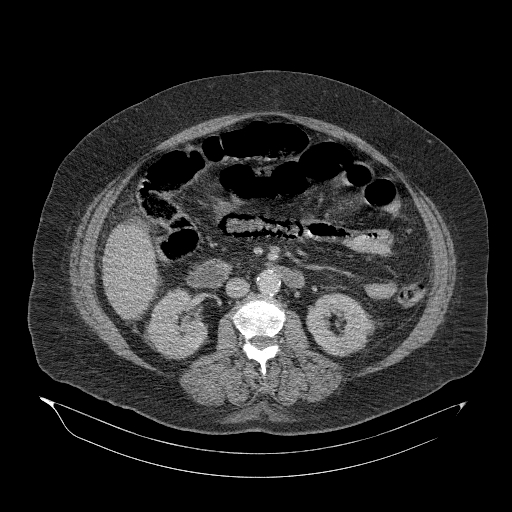 Acute superior mesenteric artery occlusion (Radiopaedia 51288-56960 Axial C+ portal venous phase 47).jpg