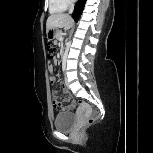 File:Acute uncomplicated appendicitis (Radiopaedia 73704-84499 Sagittal C+ portal venous phase 115).jpg