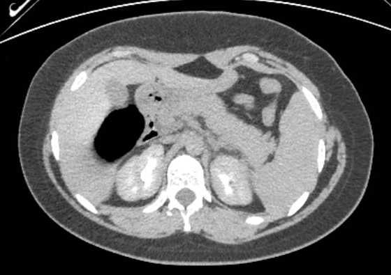 Acute unilateral nonhemorrhagic adrenal infarction (Radiopaedia 67560-76957 Axial renal excretory phase 36).jpg