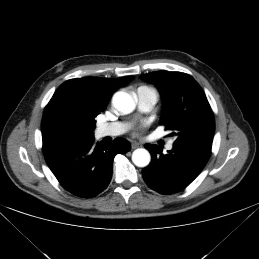 File:Adenocarcinoma of the lung (Radiopaedia 59871-67325 Axial C+ arterial phase 46).jpg
