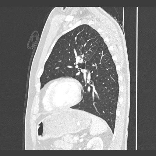 Adenocarcinoma of the lung (Radiopaedia 59871-67325 Sagittal lung window 73).jpg