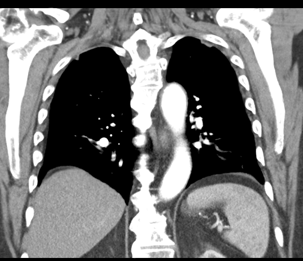Adenocarcioma of rectum- T1 lesion (Radiopaedia 36921-38547 Coronal C+ arterial phase 43).png