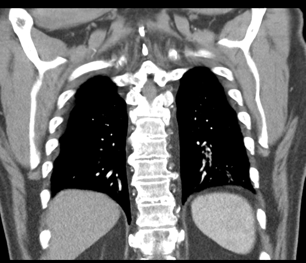 Adenocarcioma of rectum- T1 lesion (Radiopaedia 36921-38547 Coronal C+ arterial phase 49).png