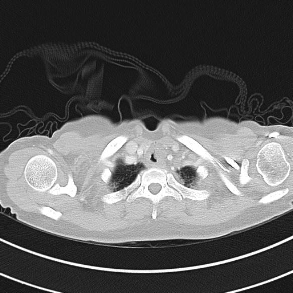File:Adenocystic carcinoma of the trachea (Radiopaedia 47677-52525 Axial lung window 30).jpg