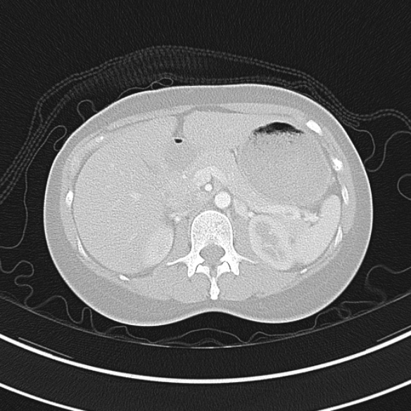 Adenocystic carcinoma of the trachea (Radiopaedia 47677-52525 Axial lung window 83).jpg