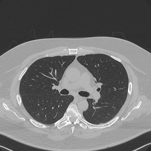 Adenoid cystic carcinoma of the trachea (Radiopaedia 49042-54137 Axial lung window 145).jpg