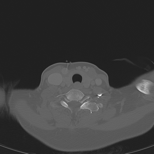 Adenoid cystic tumor of palate (Radiopaedia 46980-51518 Axial bone window 58).png