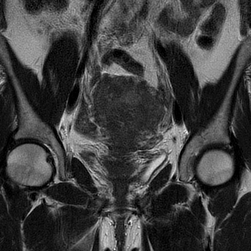 File:Adenomyosis-scar endometriosis (Radiopaedia 65863-75022 Coronal T2 13).jpg