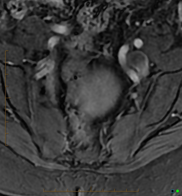 Adenomyosis uterus with hematometra (Radiopaedia 45779-50011 Axial T1 C+ fat sat 1).jpg