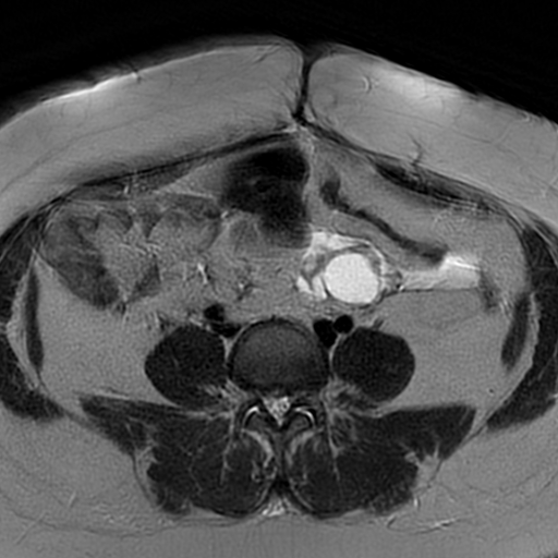 File:Adenomyosis within a didelphys uterus (Radiopaedia 70175-80215 Axial T2 2).jpg