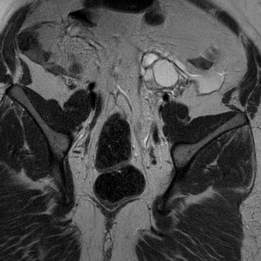 File:Adenomyosis within a didelphys uterus (Radiopaedia 70175-80215 Coronal T2 25).jpg