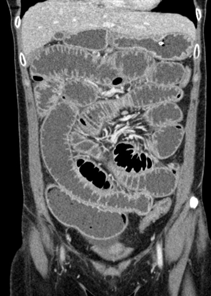 File:Adhesional small bowel obstruction (Radiopaedia 48397-53305 Coronal C+ portal venous phase 114).jpg