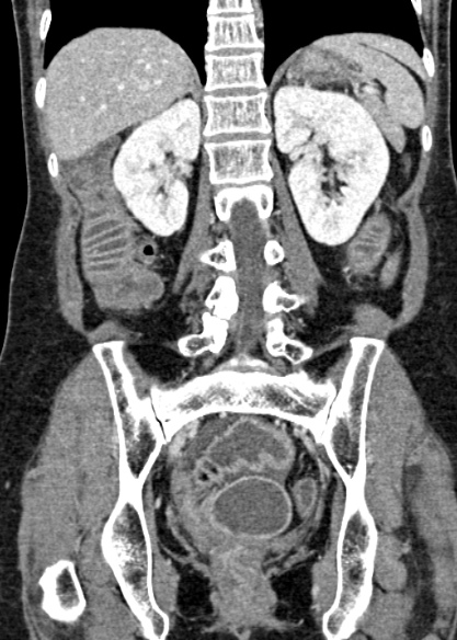 Adhesional small bowel obstruction (Radiopaedia 48397-53305 Coronal C+ portal venous phase 239).jpg