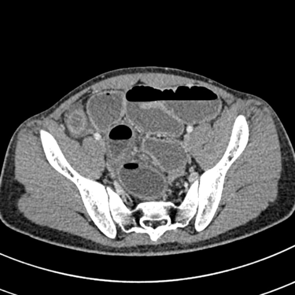 Adhesional small bowel obstruction (Radiopaedia 52107-57980 Axial C+ portal venous phase 102).jpg