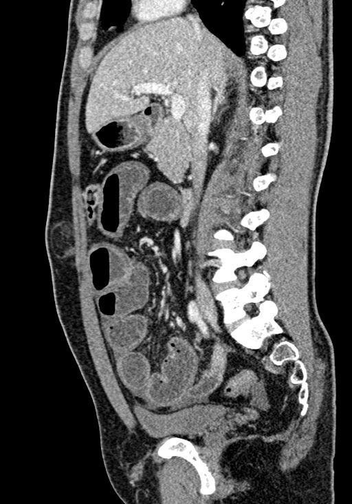 Adhesional small bowel obstruction (Radiopaedia 58900-66131 Sagittal C+ portal venous phase 106).jpg