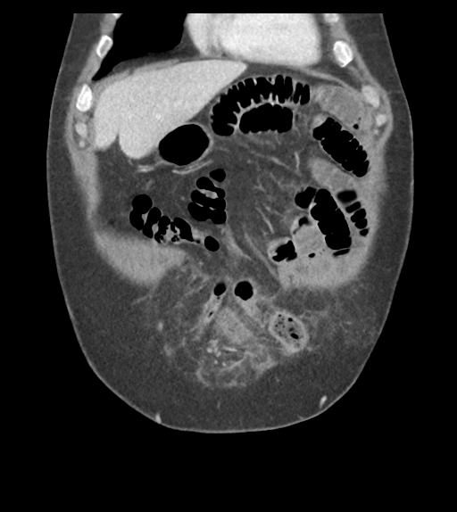 Adhesions within abdominal wall hernia (Radiopaedia 58283-65394 Coronal C+ portal venous phase 18).png