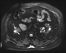 Adrenal cortical carcinoma (Radiopaedia 64017-72770 Axial DWI 21).jpg