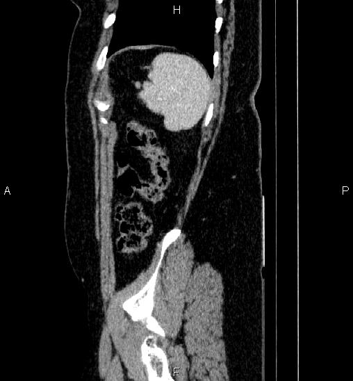 Adrenal cortical carcinoma (Radiopaedia 84882-100379 Sagittal C+ portal venous phase 76).jpg