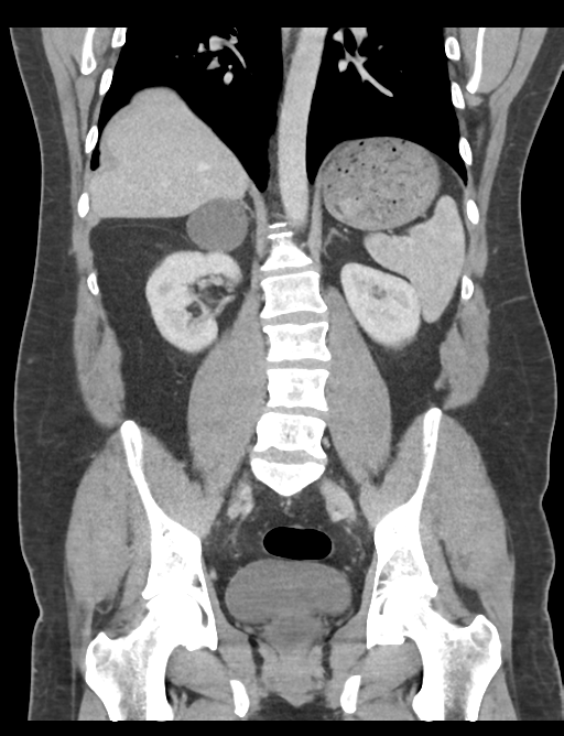 Adrenal cyst (Radiopaedia 45625-49777 Coronal C+ portal venous phase 46).png