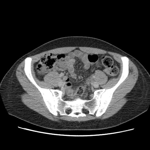 Adrenal cyst (Radiopaedia 64869-73813 Axial C+ portal venous phase 59).jpg