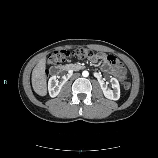 Adrenal cystic lymphangioma (Radiopaedia 83161-97534 Axial C+ arterial phase 44).jpg