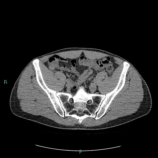Adrenal cystic lymphangioma (Radiopaedia 83161-97534 Axial non-contrast 76).jpg