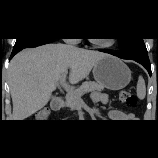 File:Adrenal gland trauma (Radiopaedia 81351-95079 Coronal non-contrast 38).jpg