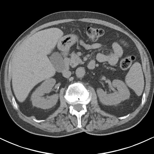 File:Adrenal hematoma (Radiopaedia 44334-47967 Axial non-contrast 37).png