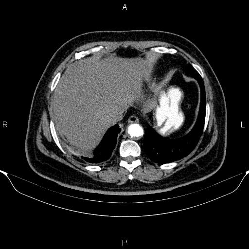 Adrenal hemorrhage (Radiopaedia 62622-70916 Axial C+ arterial phase 37).jpg