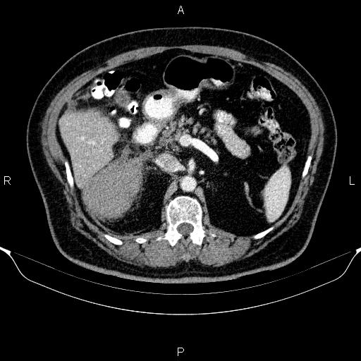 Adrenal hemorrhage (Radiopaedia 62622-70916 Axial C+ portal venous phase 66).jpg