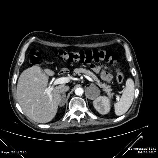 Adrenal metastasis (Radiopaedia 78425-91079 Axial C+ arterial phase 28).jpg