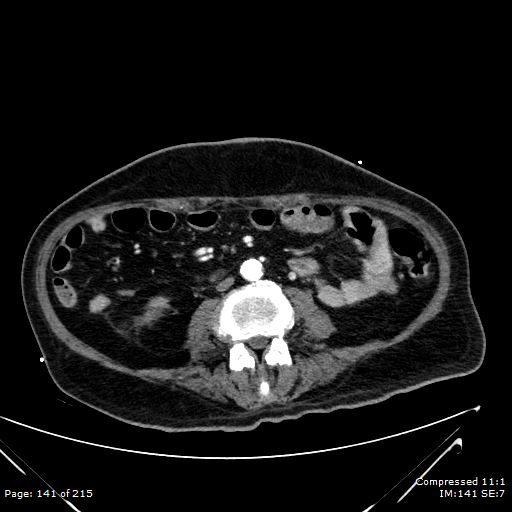 File:Adrenal metastasis (Radiopaedia 78425-91079 Axial C+ arterial phase 71).jpg