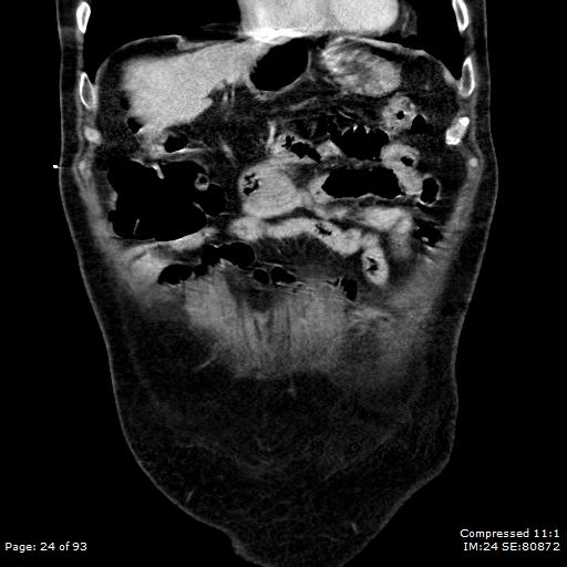File:Adrenal metastasis (Radiopaedia 78425-91079 Sagittal C+ portal venous phase 11).jpg