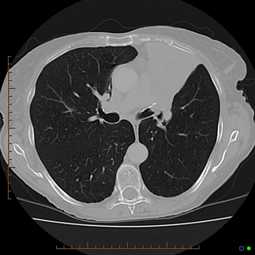 File:Adrenal metastasis from small cell lung cancer (Radiopaedia 19133-19108 Axial lung window 1).jpg
