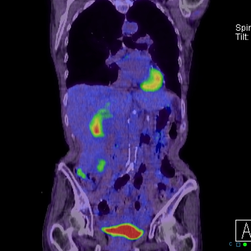 File:Adrenal metastasis from small cell lung cancer (Radiopaedia 19133-19109 Coronal 13).jpg