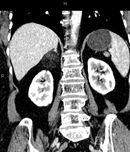 Adrenal myelolipoma (Radiopaedia 82742-96986 Coronal renal cortical phase 51).jpg