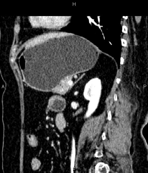 File:Adrenal myelolipoma (Radiopaedia 82742-96986 Sagittal renal cortical phase 70).jpg