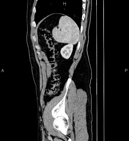 Adrenal myelolipoma (Radiopaedia 87794-104246 Sagittal renal cortical phase 81).jpg