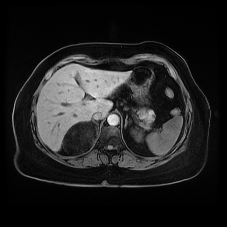 Adrenal myelolipoma - MRI (Radiopaedia 83249-97646 Axial T1 fat sat 20).jpg