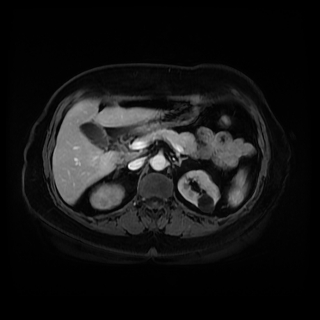 Adrenal myelolipoma - MRI (Radiopaedia 83249-97646 T1 fat sat arterial phase 35).jpg