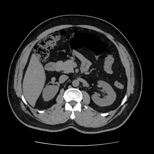 Adrenal myelolipoma and beaver tail liver (Radiopaedia 86201-102193 Axial non-contrast 187).jpg
