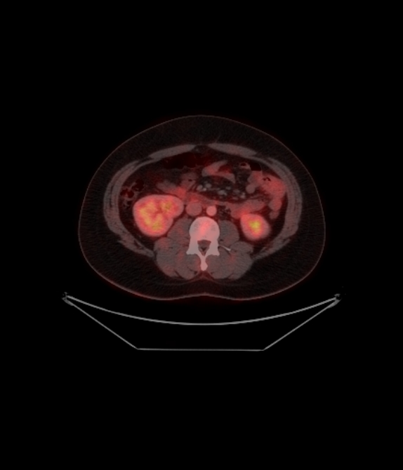 Adrenocortical carcinoma (Radiopaedia 80134-93440 ِAxial 187).jpg
