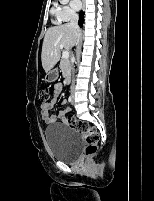 Adrenocortical carcinoma (Radiopaedia 87281-103569 Sagittal C+ portal venous phase 141).jpg