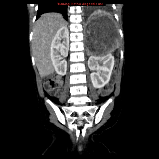 File:Adrenocortical carcinoma (Radiopaedia 9449-10131 Coronal C+ portal venous phase 14).jpg