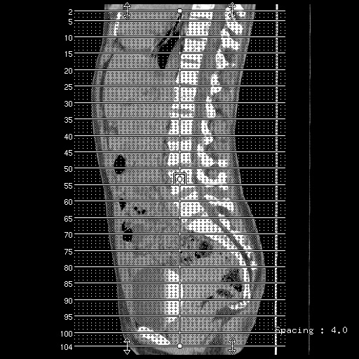 File:Adult polycystic kidney disease (Radiopaedia 48845-53876 Axial renal excretory phase 1).jpg