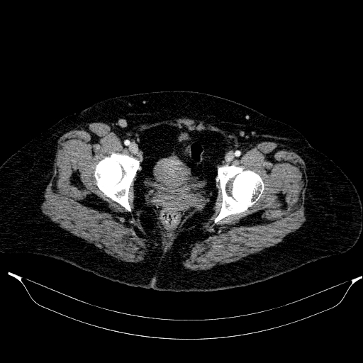 File:Afferent loop syndrome - secondary to incarcerated trocar site hernia (Radiopaedia 82959-97305 Axial C+ portal venous phase 221).jpg