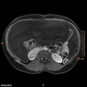 File:Aggressive angiomyxoma (Radiopaedia 73343-84093 Axial T1 C+ fat sat 148).jpg