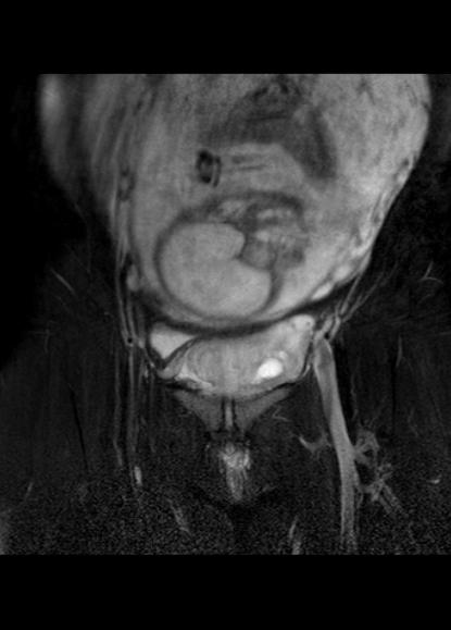 File:Aggressive angiomyxoma of the pelvis and perineum (Radiopaedia 59162-66479 Coronal T2 fat sat 6).jpg