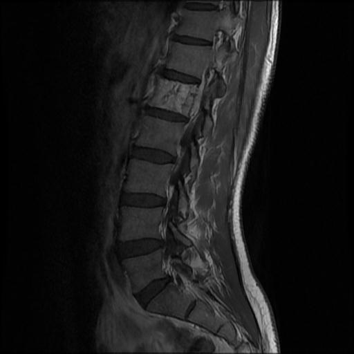 File:Aggressive vertebral hemangioma with pathological fracture (Radiopaedia 69528-79411 Sagittal T1 C+ 3).jpg