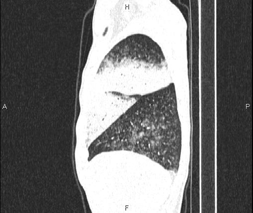 File:Air bronchogram in pneumonia (Radiopaedia 85719-101512 Sagittal lung window 16).jpg